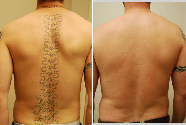 Bonsai Tattoo Removal